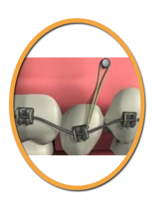 implant-orthodontiste